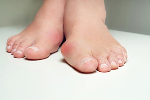 Treatment Options for Bunions