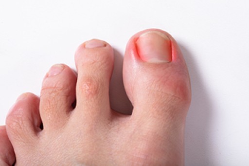 What Is an Ingrown Toenail?