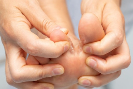 Dealing With Athlete’s Foot