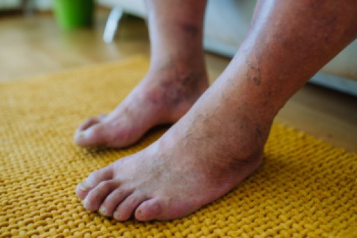 Foot Care for Diabetics