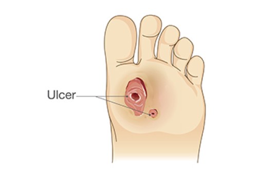 Foot Ulcers From Neuropathy