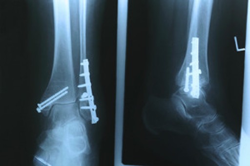 Diagnosing and Healing Stress Fractures